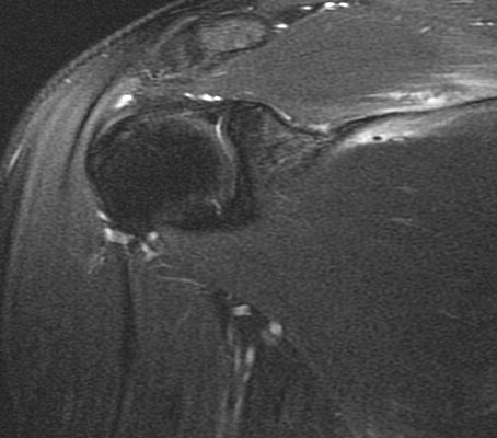Figure 1 for case scapular fracture and supraspinatus and subscapularis muscle strain ( RID1860 ) ( RID1870 )